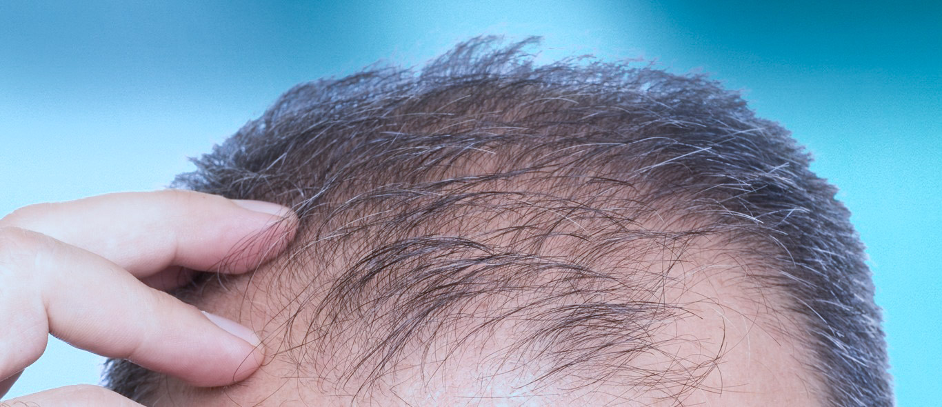 Androgenetic Alopecia